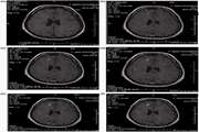 Evaluation of plaque detection and optimum time of enhancement in acute attack multiple sclerosis after contrast injection